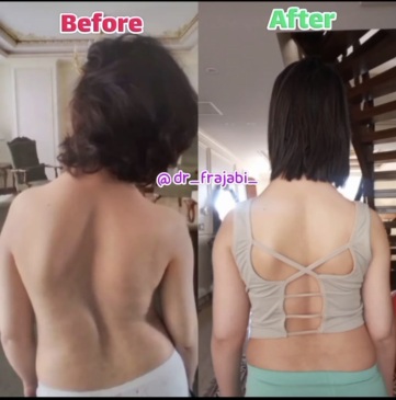 اصلاح ناهنجاری اسکولیوز 2 قوسی 