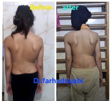 اصلاح ناهنجاری اسکولیوز 3 قوسی