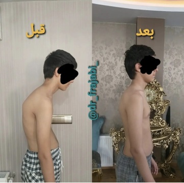 اصلاح ناهنجاری قوز پشتی