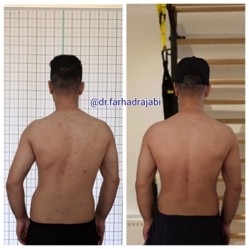 اصلاح ناهنجاری اسکولیوز